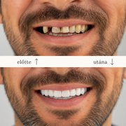 SMILEFIT PRO – PODESIVI SET PROTEZA ZA SAVRŠEN OSMIJEH